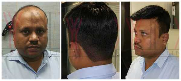 Hair Replacement in Sector-12-Gurgaon

 