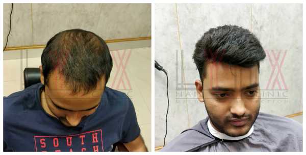 Hair Replacement in Sector 13 Gurgaon 
