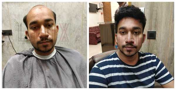 Hair Replacement in Sector 22 Gurgaon 
