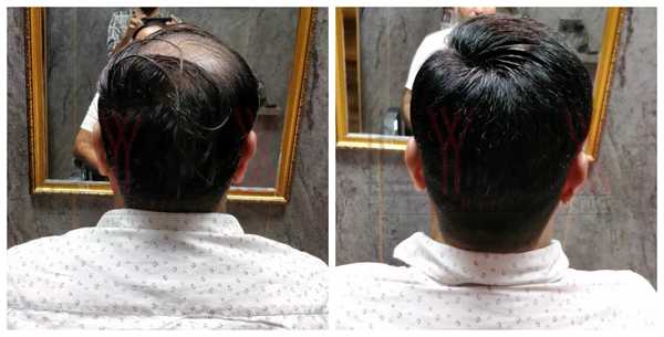 Hair Replacement in Sector 28Gurgaon -

