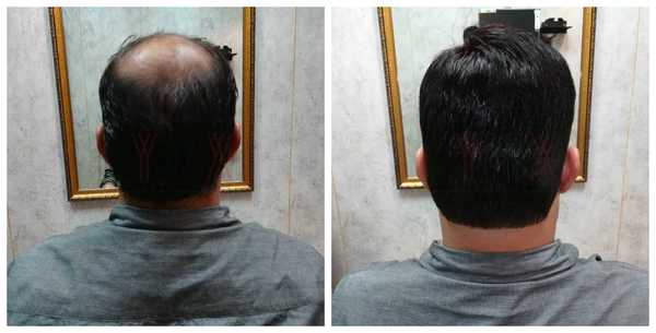 Hair Replacement in  Sector 30 Gurgaon 
