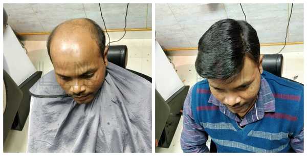 Hair Replacement in  Sector 31 Gurgaon 
