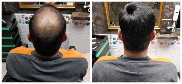 Hair Replacement in Sector 38 Gurgaon 

