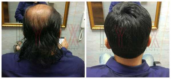 Hair Replacement in Sector 39 Gurgaon 

