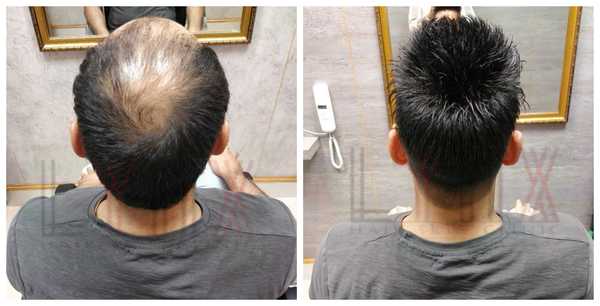Hair Replacement in Sector 41 Gurgaon 
