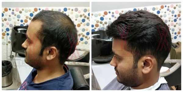 Hair Replacement in Sector 42 Gurgaon 
