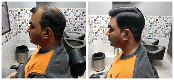 Hair Replacement in Sector 53 Gurgaon 

