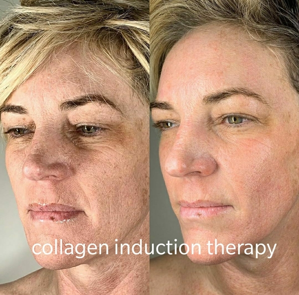 fat reduction