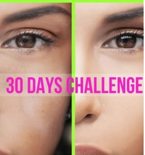 age spots