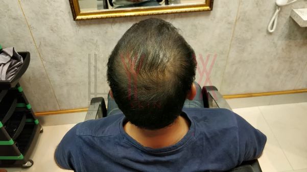 Hair Patch in Bawadi-

A hair patch in B