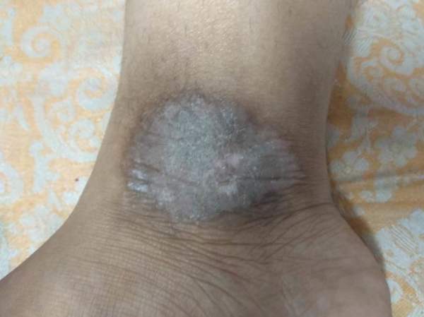 Skin diseases in india