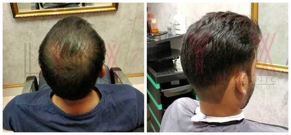 Hair Patch in Sector 24 Rohini Delhi-

T