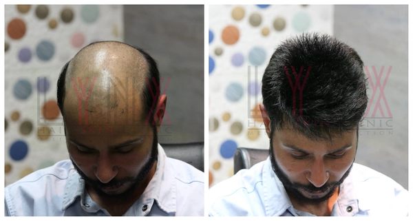 Hair Patch in  Wazirpur Delhi-

The Hair