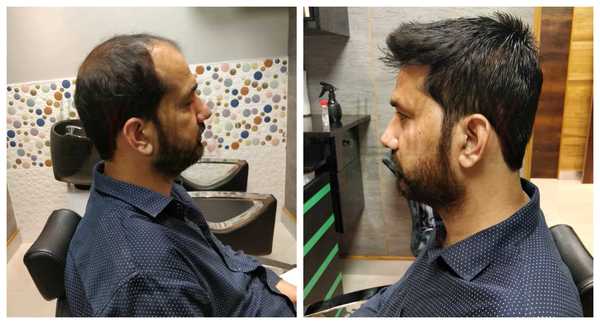 Hair Patch in Tukhmirpur Delhi-
The Hair