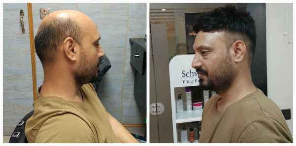 Hair Patch in Tughlakabad Extention Delh