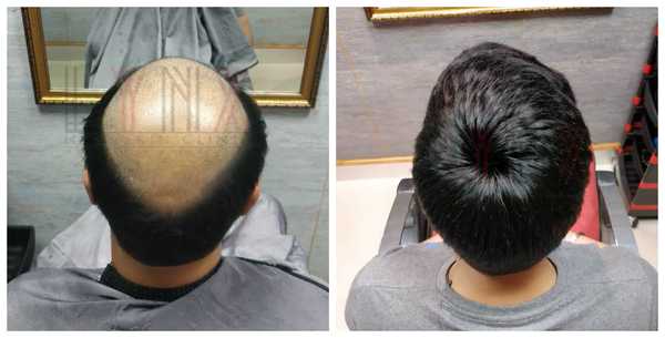 Hair Patch in Tri Nagar Delhi-
The Hair 