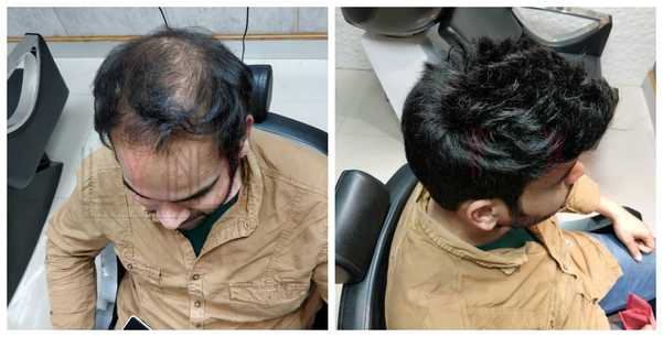 Hair Patch in Taimoor Nagar Delhi-

The 