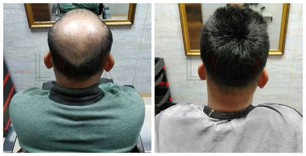 Hair Patch in Swasthya Vihar Delhi-

The