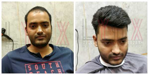 Hair Patch in Shree Nagar Delhi-
The Hai