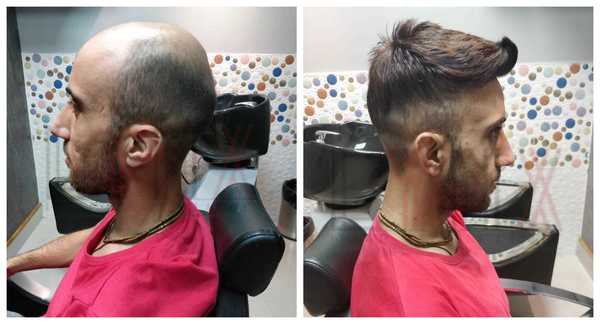 Hair Patch in Sheikh Sarai Phase 2 Delhi