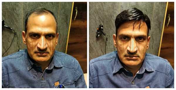 Hair Patch in Shalimar Garden Extention 