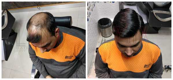 Hair Patch in Shakurpur Colony Delhi-
Th