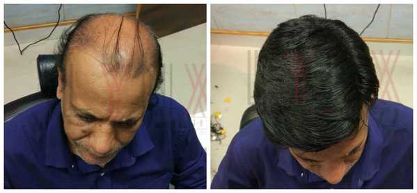 Hair Patch in Sector 8 Rama Krishna Pura