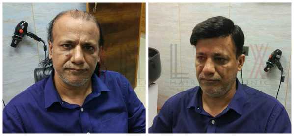 Hair Patch in Sector 10 Vasundhara Delhi