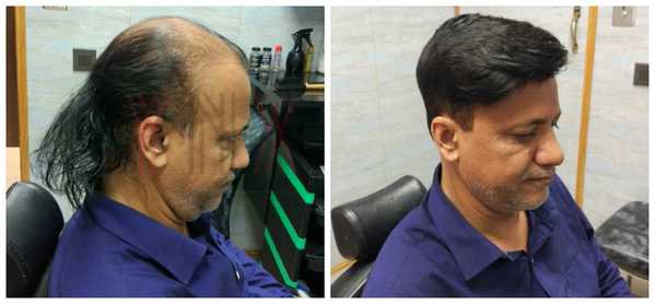 Hair Patch in  Sector 15 Vasundhara Delh