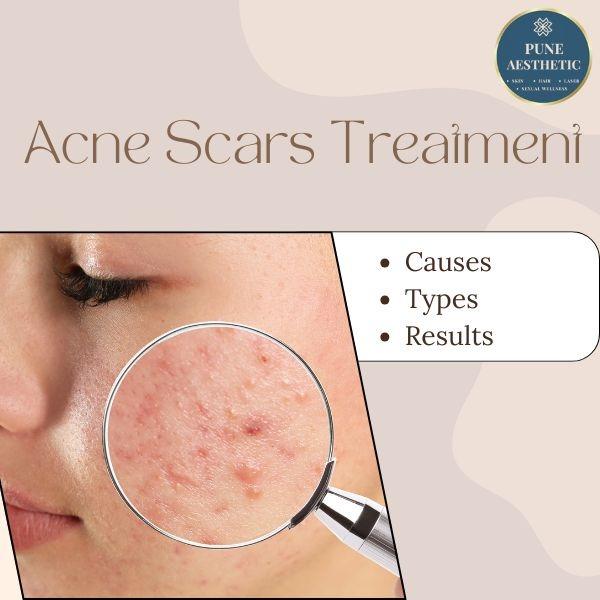 microneedling radiofrequency t