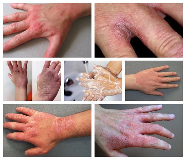 Search Personal Skin Care Tips Dr Shreya S Allskin Clinic Indore