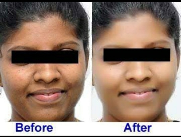 skin lightening treatments in 