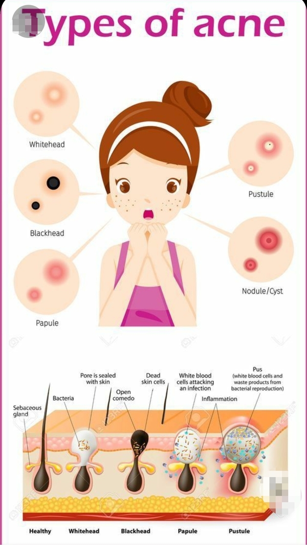 dermal fillers and collagen st