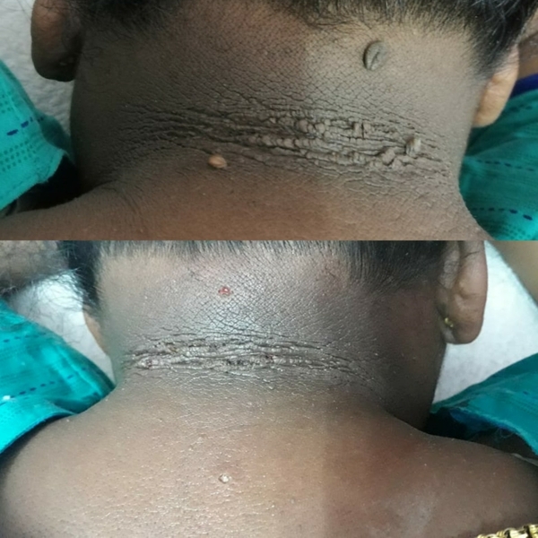 wart removal in chennai withou