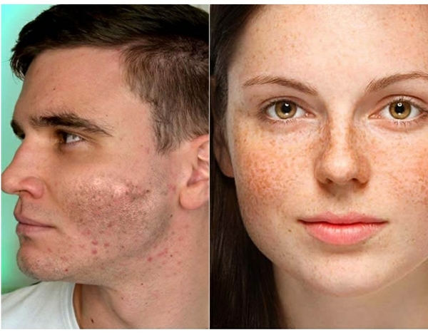 microdermabrasion