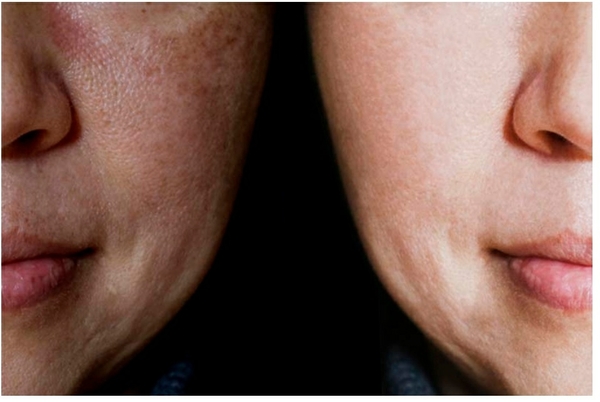 superficial skin