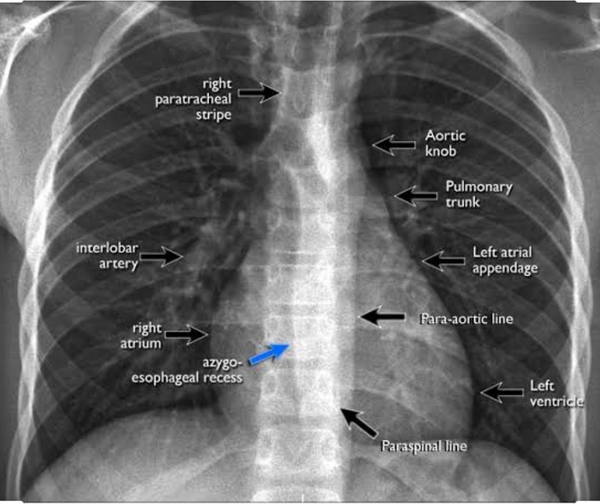 Chest X Ray ???
@diagnosticc