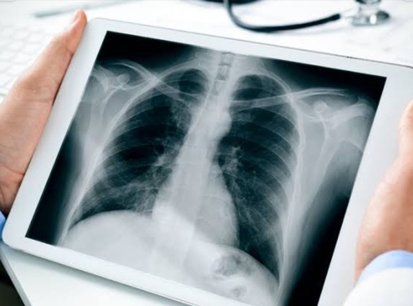 CHEST X RAY
OR
DIGITAL CHEST X