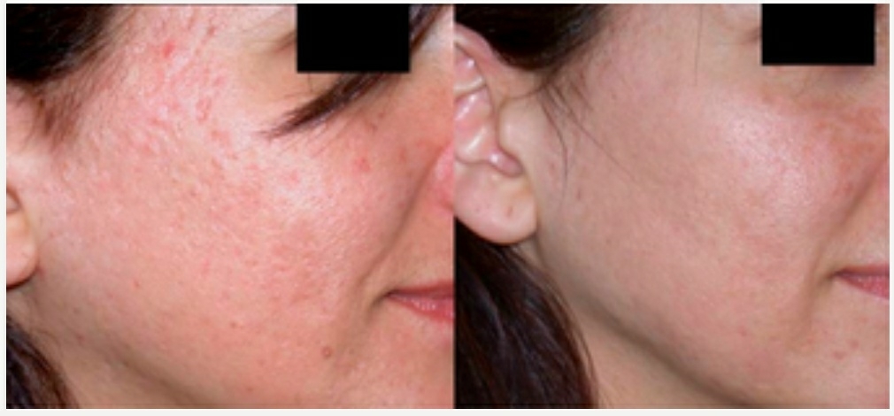 non invasive skin cleansing an