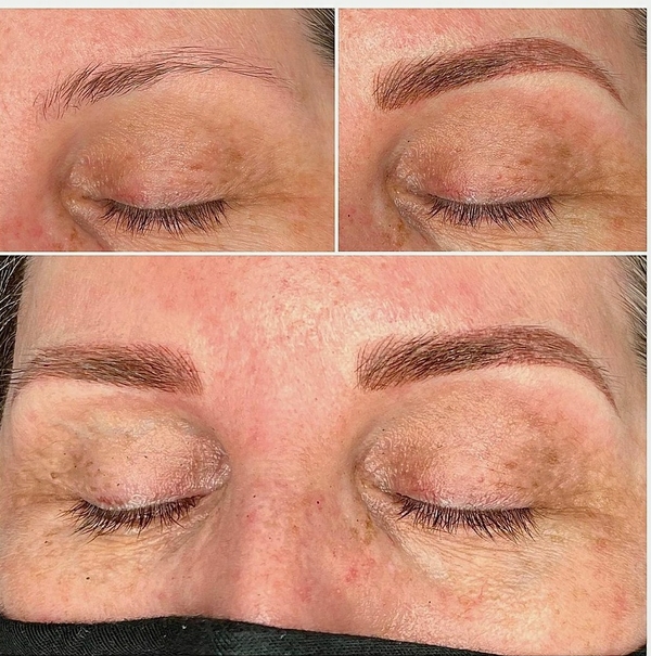 dermal fillers and collagen st