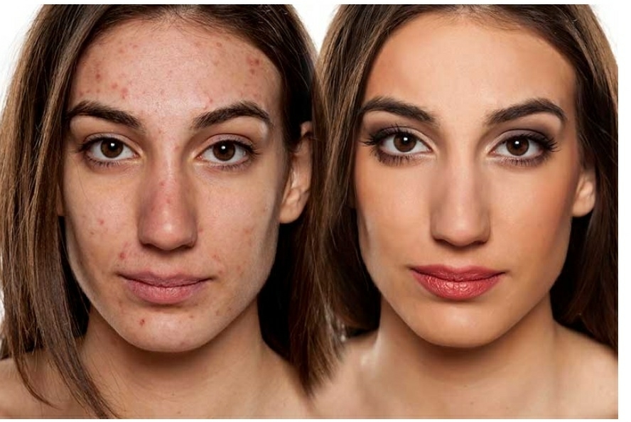 age spots