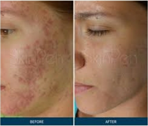 uneven texture