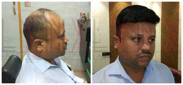Hair Patch in Gurgaon-


A hair patch is