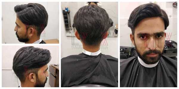 Non-surgical Hair Replacement in Gurgaon