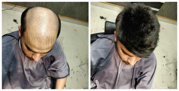 Gents Hair Weaving in Gurgaon-

Hair Los