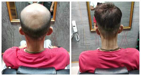 Gents Hair Wigs in Gurgaon-
Most of the 