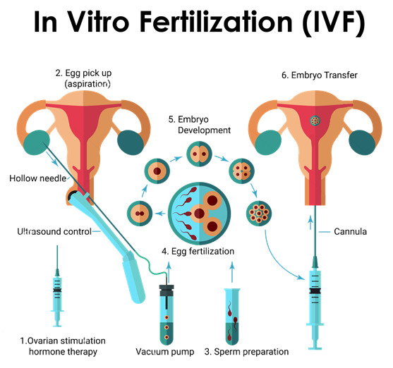 ivf fertility related problem