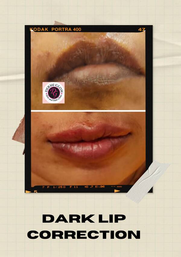 dark lip correction