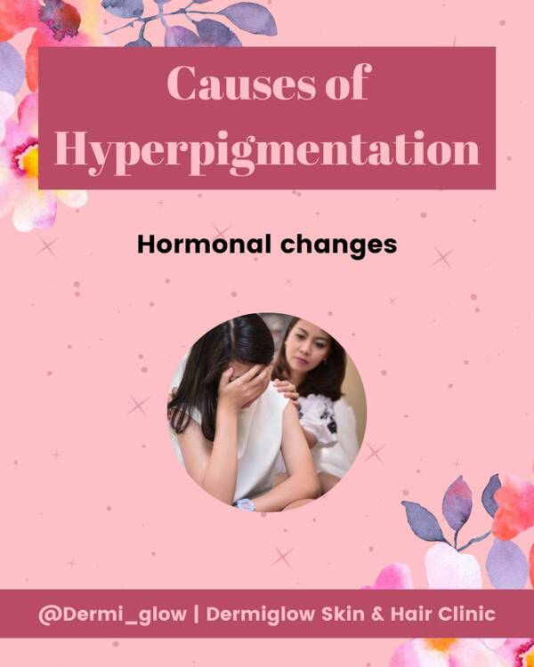 hyperpigmentation