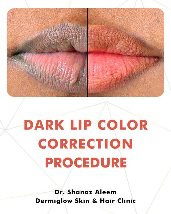 dark lip correction